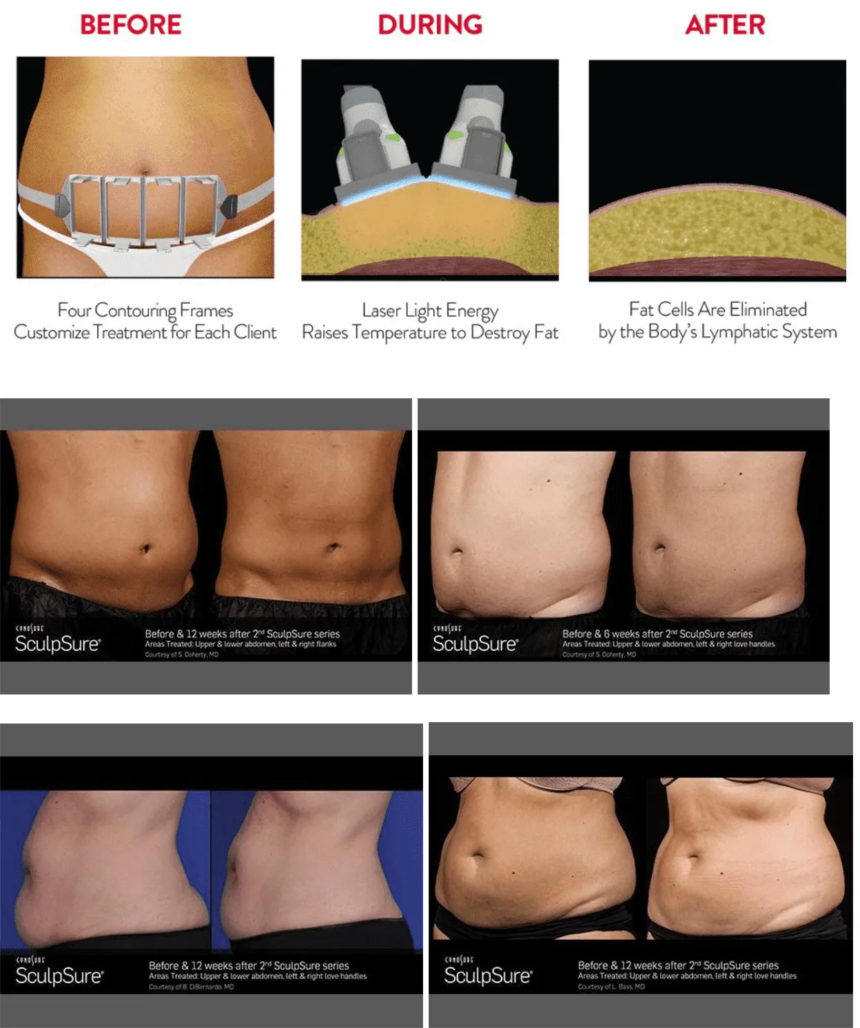 دستگاه لاغری Sculpsure slimming machine
